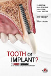 Tooth or Implant, The recovery or replacement of the severely compromised natural tooth | 9781957260525 | Portada